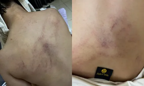 Tin mới nhất vụ bé gái 4 tuổi bị giáo viên đánh đập, ném vào tường