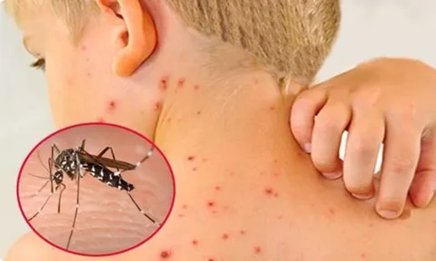 Sốt xuất huyết tăng “nóng” giữa mùa mưa, WHO khuyến nghị tiêm vắc-xin