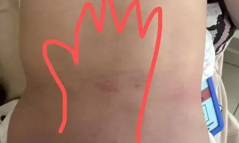 Mẹ âm thầm báo cảnh sát khi thấy vết lạ trên lưng con 14 tháng tuổi, kết quả khám khiến bà rụng rời chân tay