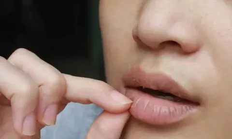 'Nghiện' son dưỡng khi môi khô nứt, nhưng càng thoa lại càng khô