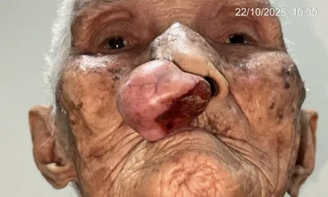 Phẫu thuật cho cụ bà gần 100 tuổi sau 30 năm sống chung với khối u trên mặt