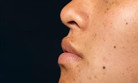 Tại sao mụn không nặn vẫn để lại vết thâm?