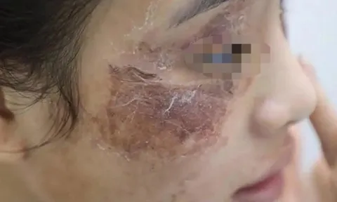 Cô gái bị tàn phá dung nhan vì bôi kem mua trên mạng