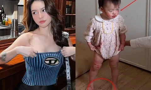 Hốt hoảng khi 2 con gái mặt mũi, chân tay đỏ choe choét, biết lý do, mẹ Việt tức giận