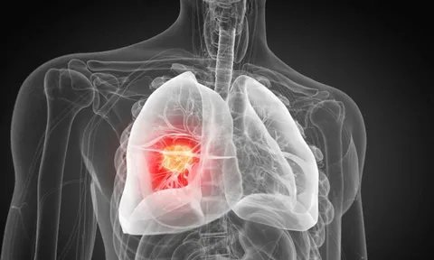 Phát hiện nguyên nhân gây ung thư phổi chưa từng biết