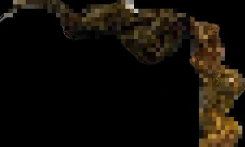 Bé gái 9 tuổi có thói quen lạ đời, bác sĩ gắp ra thứ "đáng sợ" trong bụng