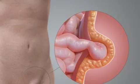 Bé gái quấy khóc vì khối phồng bẹn: Cảnh báo bố mẹ đừng chủ quan