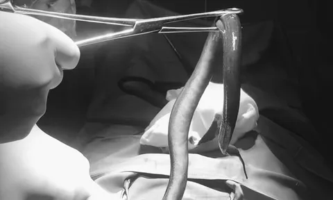 Bụng "cứng như gỗ", người đàn ông sốc nặng khi biết có con vật bơi trong bụng mình