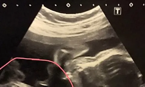 Đi khám thai, người phụ nữ 32 tuổi sốc nặng khi thấy kết quả siêu âm