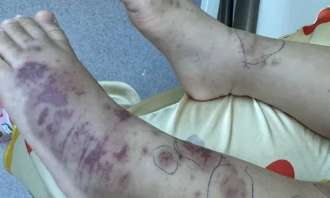 Chuyên gia cảnh báo về một căn bệnh nguy hiểm, lây lan nhanh, tỉ lệ tử vong cao