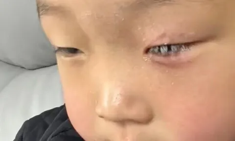 Con bị keo 502 bắn vào mắt, bố nhẹ nhàng đổ thêm một thứ, bác sĩ khen: Hiếm có người thông minh như anh!