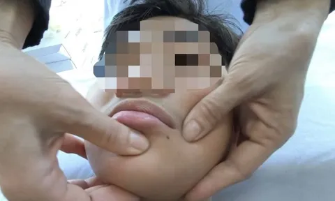 Miền Bắc rét sâu, gia tăng số người bị méo miệng: Chuyên gia chỉ cách bảo vệ sức khỏe "vàng"