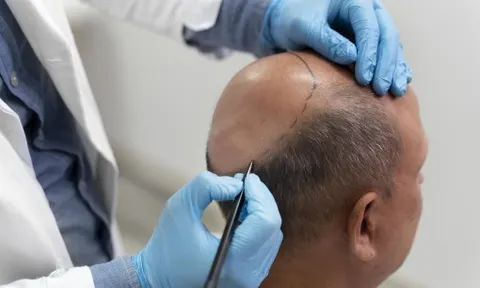 Nam giới cần biết gì trước khi quyết định cấy tóc vì hói?