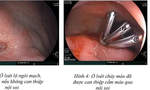 16 tuổi đã xuất huyết dạ dày và cảnh báo từ bác sĩ