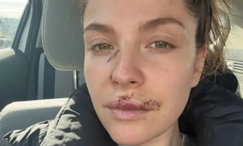 Nữ diễn viên 37 tuổi lộ gương mặt đầy vết thương sau vụ bị chó cắn