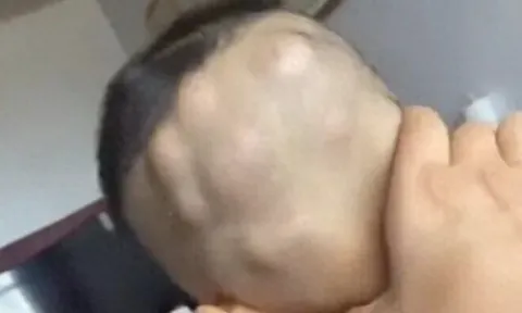 Mẹ tắm cho con 6 tuổi thì điếng người phát hiện đầu bé mọc đầy khối u to, đến bệnh viện bác sĩ nói: Thật hiếm gặp!