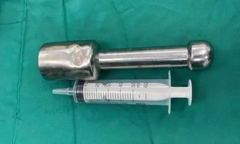 Thiếu niên 15 tuổi mắc kẹt chày kim loại dài 18 cm ở trực tràng