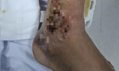 Đắp thuốc, một người đàn ông suýt mất chân