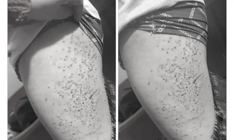 Học sinh lớp 7 bị bạn dùng bút bi đâm chi chít vào đùi