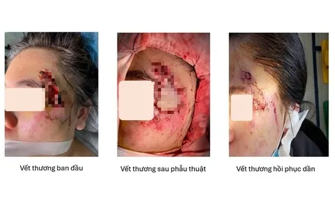 Ghép da thành công cho cô gái bị hoại tử vùng mặt sau tai nạn giao thông