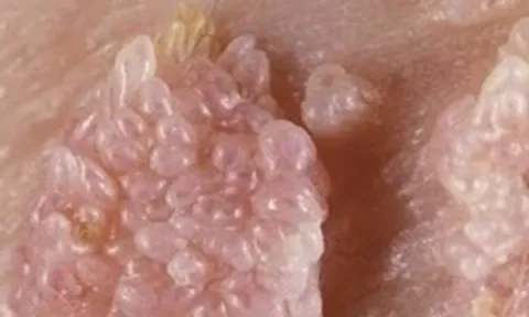 Người đàn ông gần 70 tuổi mắc sùi mào gà sau quan hệ không an toàn