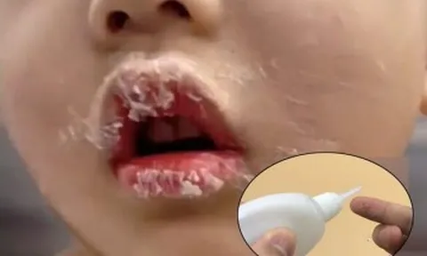 Tưởng keo 502 là son, bé gái bôi lên môi liền bị dính chặt, mẹ tưới thêm 1 thứ được BS khen: Thông minh quá!