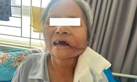 Phát hiện ung thư từ một vết loét ở miệng