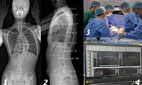 Cô gái soi gương thấy lưng có dấu hiệu lạ, không ngờ cột sống đã cong 53 độ