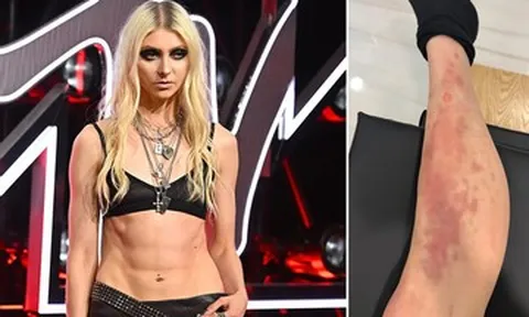 Nữ ca sĩ 33 tuổi nhập viện cấp cứu vì bị nhện độc cắn