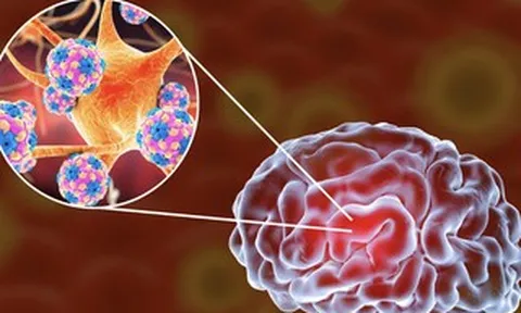 Bệnh nhi 2 tuổi bị viêm não mô cầu đã không qua khỏi