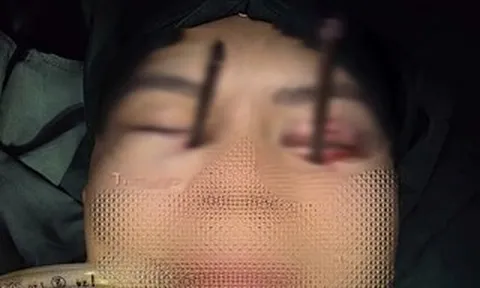 Cứu nam thanh niên bị 2 chiếc đũa đâm sâu vào 2 hốc mắt