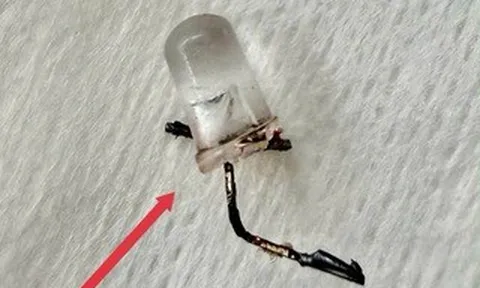 Bác sĩ thót tim gắp đèn LED nằm trong phế quản bé 9 tháng tuổi