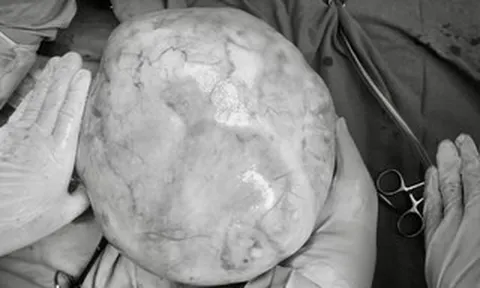 Mang khối u buồng trứng 4 kg, thiếu nữ bị nhầm là tăng cân