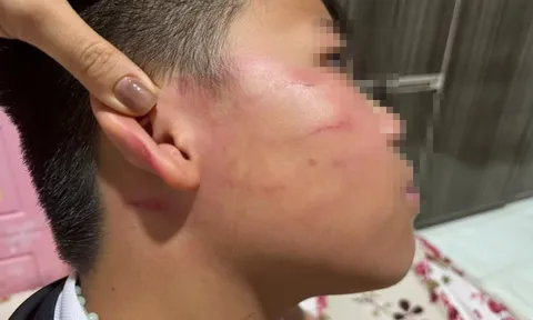 Vụ giáo viên nước ngoài tát học sinh: Gia đình nói bé trai bị thủng màng nhĩ