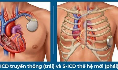 Lần đầu tiên đặt máy phá rung tim công nghệ mới