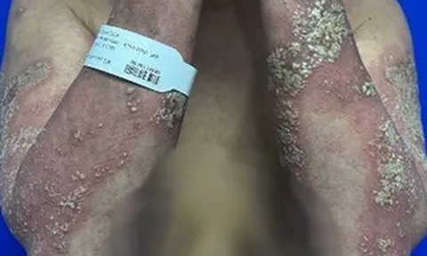 Da tổn thương toàn thân vì đợt bùng phát vảy nến hiếm gặp