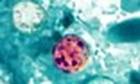 Mỹ ghi nhận ca tử vong đầu tiên liên quan đến đợt dịch Cyclospora