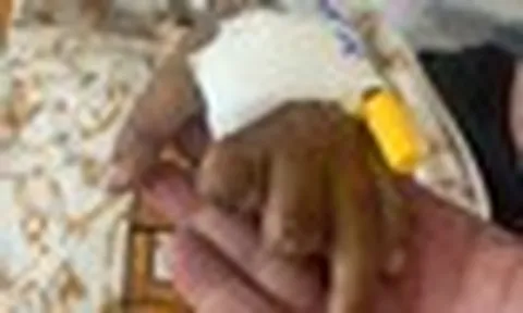 Bé trai 10 tuổi sáng đau đầu, chiều hôn mê và xuất hiện tử ban vì não mô cầu: "Tối đó chuyển lên Nhi Đồng Thành Phố, nhưng em không qua khỏi"