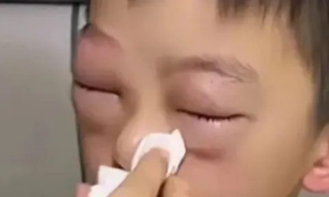 Mẹ hốt hoảng vì mắt con sưng to như quả trứng gà, nguyên nhân phía sau ai cũng "dở khóc dở cười"