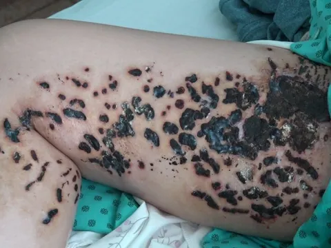 Đùi cô gái trẻ lở loét như tổ ong sau khi đốt điện chữa rạn da