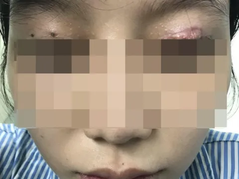 Thủng mắt, vỡ thủy tinh thể sau cắt mí làm đẹp