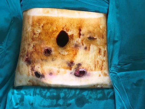 Quý bà thủng hàng chục lỗ trên cơ thể sau tiêm chất tan mỡ để có 'body' đẹp