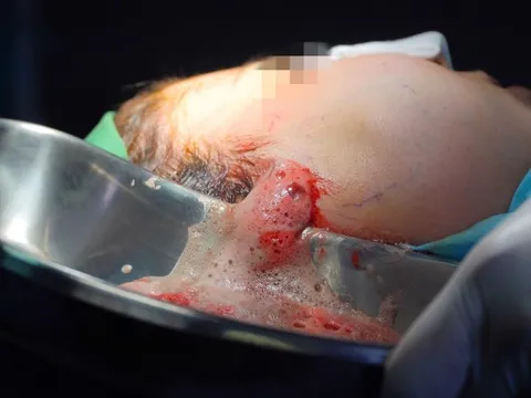 Nghe lời chiêu dụ tiêm filler để trẻ hóa, cô gái bị hoại tử mặt