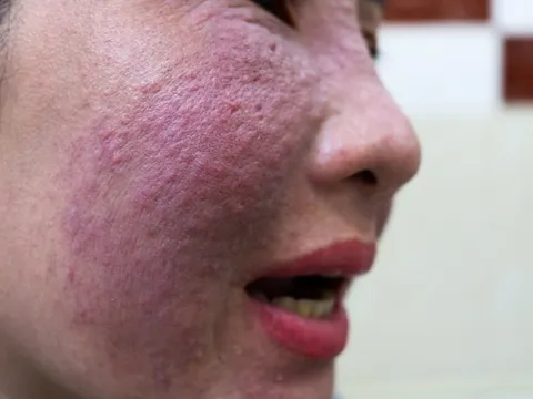 Sưng phù mặt, mụn kết tảng do làm trắng da cấp tốc