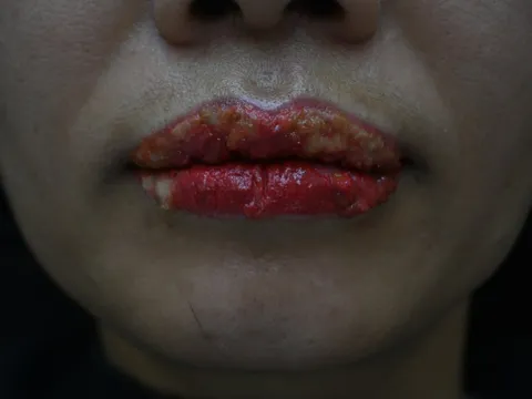 Sau làm đẹp, cô gái trẻ 'được khuyến mại' đôi môi sưng vù đầy mủ