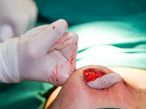 Tự tiêm thuốc tan mỡ, bụng bệnh nhân hoại tử trào mủ như 'núi lửa'