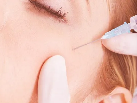 Bác sĩ hút cả lít dịch mủ trên mặt cô gái 24 tuổi bị nhiễm trùng vì tiêm fille cho...xinh