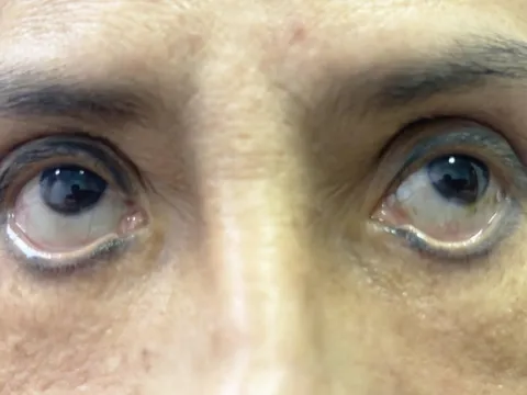 Người phụ nữ suốt ba năm 'trợn mắt' vì cắt mí