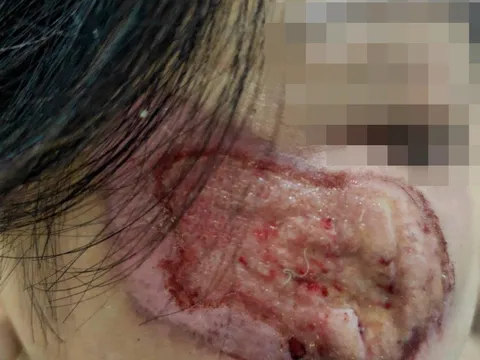 Quý bà nát hết mặt vì làm đẹp bằng dung dịch a xít