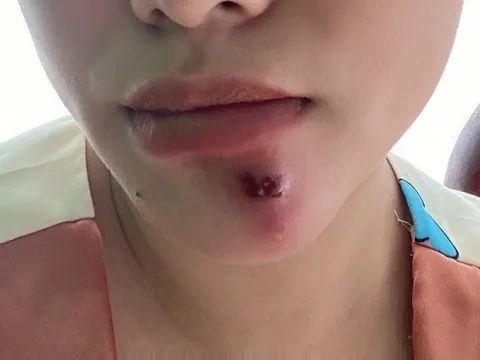 Áp xe, nhiễm trùng da do tự ý nặn mụn